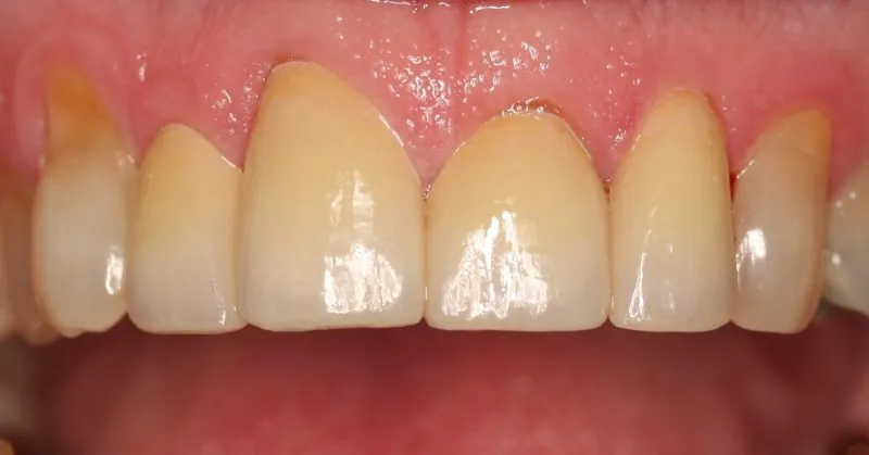 Close-up view of upper front teeth showing dental restorations, smooth enamel surfaces, and receded gumlines.