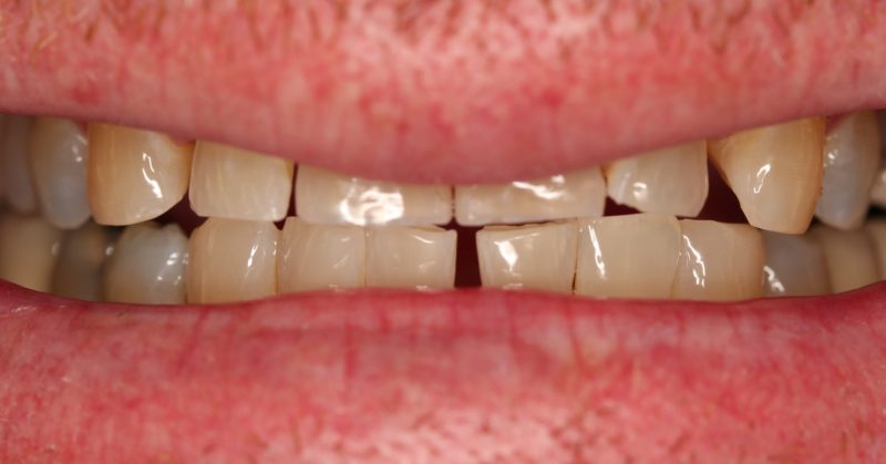 p view of a patient’s natural teeth showing mild wear, uneven alignment, and visible spacing between lower front teeth before dental treatment.